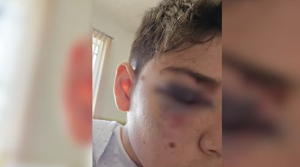 Adolescente leva três pontos no rosto após agressão em escola de Birigui