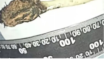 Homem descobre que escova de dente engolida na infância estava no intestino há 52 anos