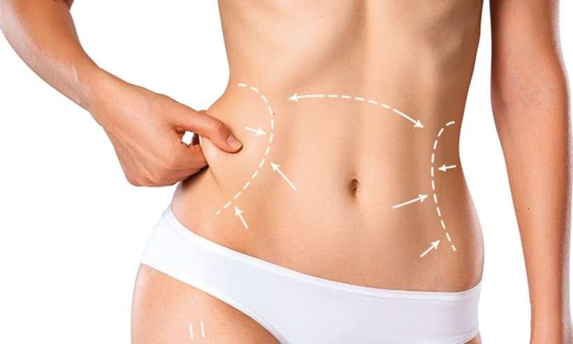 Especialista tira as principais dúvidas sobre abdominoplastia