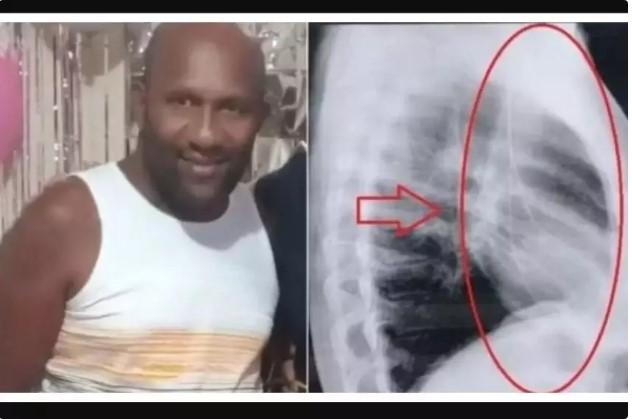 Por erro médico, homem convive com fio próximo ao coração