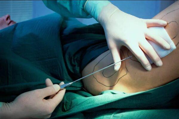 Médicos alertam sobre riscos de lipoaspiração fora de hospital