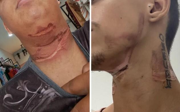 Entregadores têm pescoços atingidos por fios soltos em ruas de Fernandópolis: 'Senti queimando'