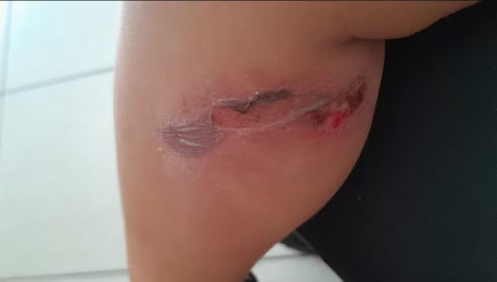 Prefeitura de Votuporanga é condenada a indenizar mãe por queimadura em creche