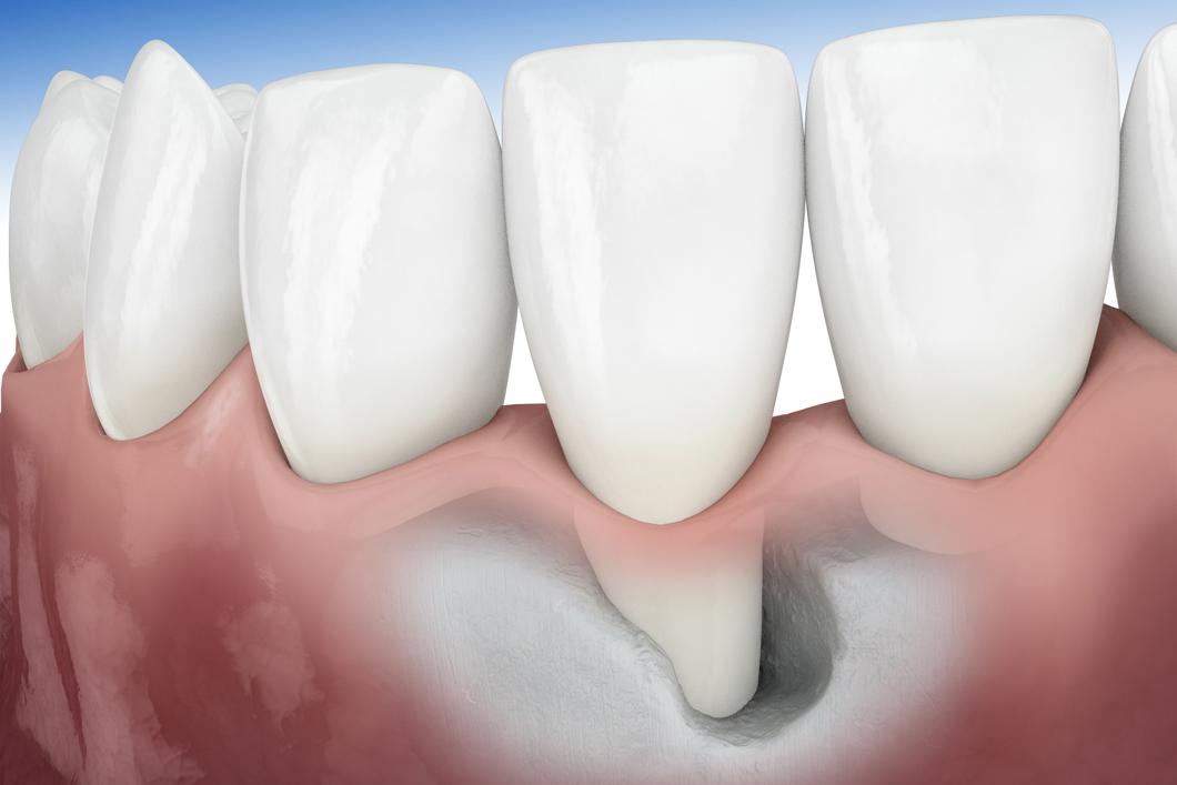 Recuperados da COVID-19 estão relatando perda de dentes saudáveis