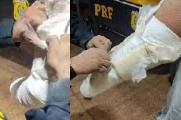 Preso fingia ter braço quebrado para transportar cocaína em gesso